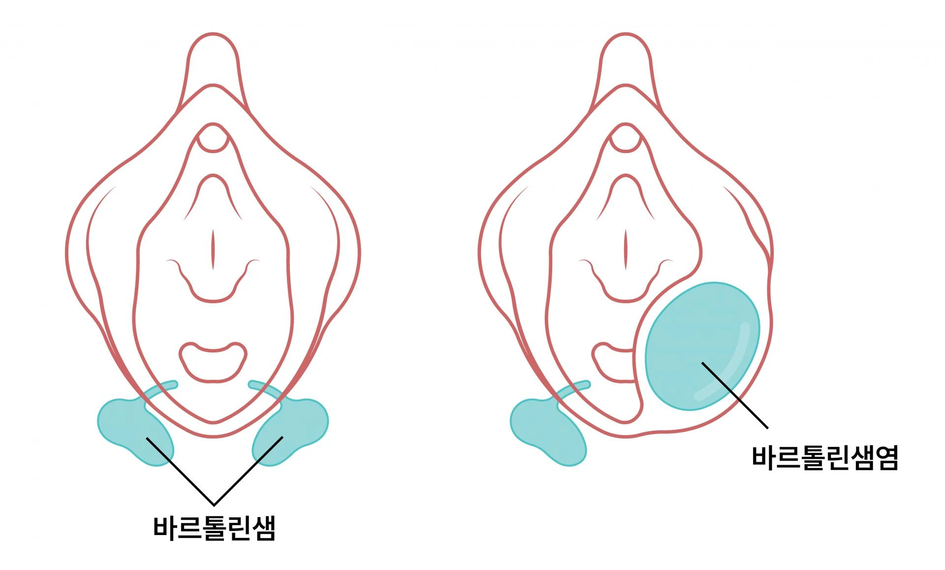 외음부가 간지러울 때 의심해봐야 할 질환 — 차차여성의원 내몸이야기 이미지 1