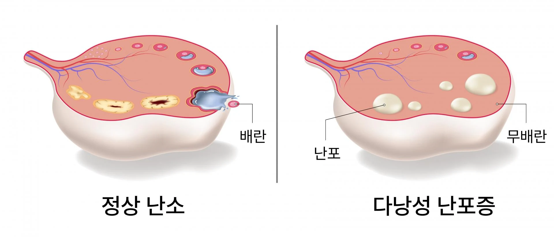 다낭성 난포증, 치료하지 않으면 불임으로 나타나 — 차차여성의원 내몸이야기 이미지 1